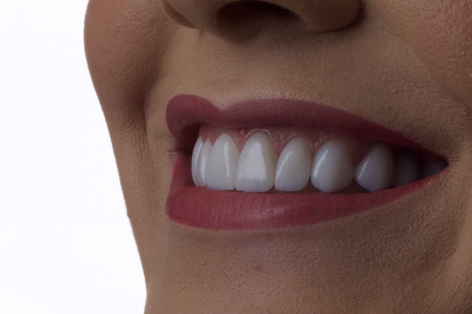 Caso Clínico 2 - Harmonização do Sorriso